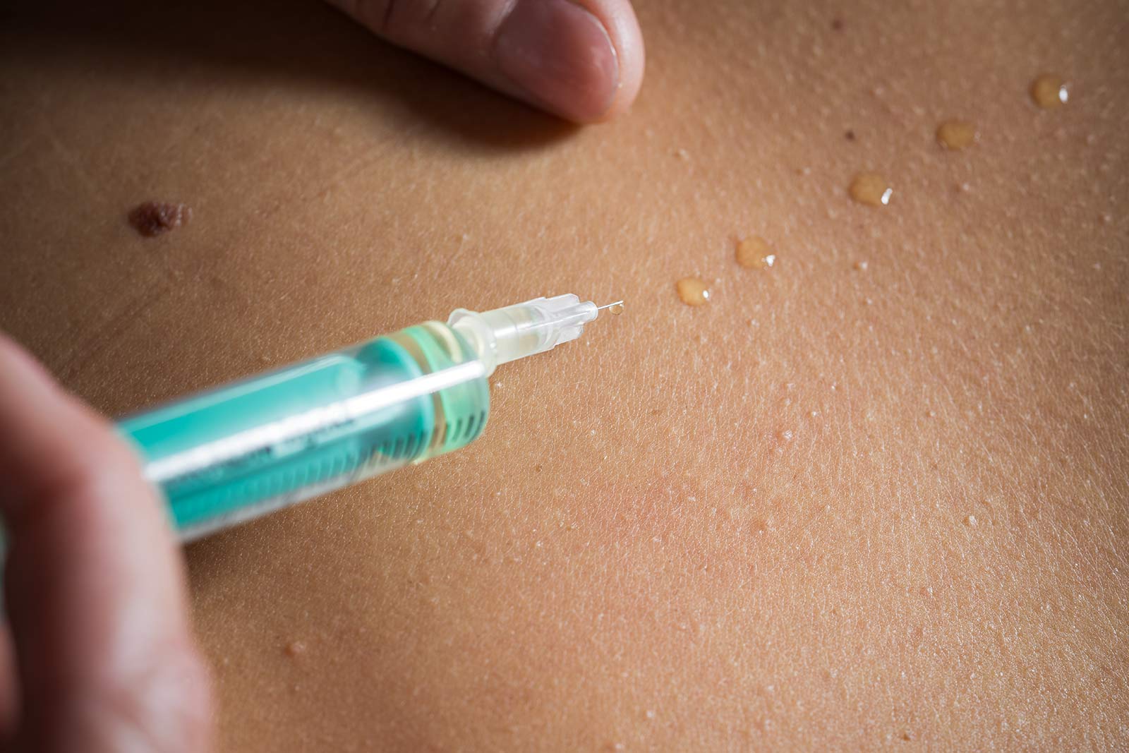 Lara Müllneritsch | Mesotherapie
