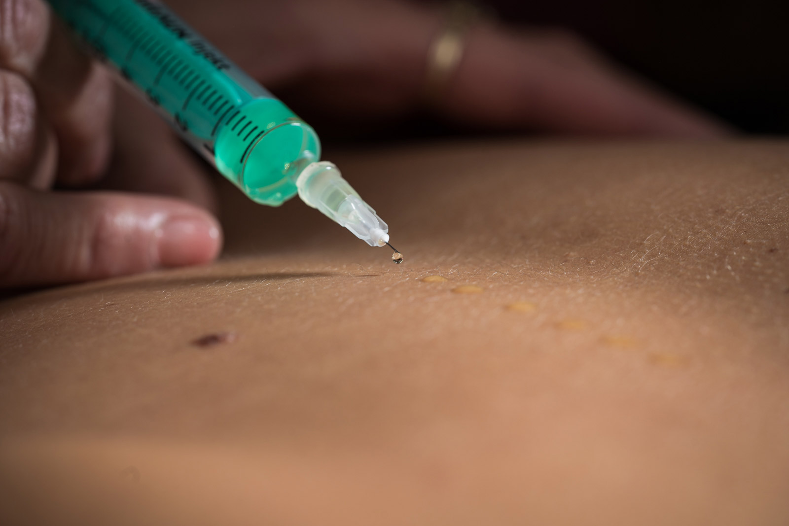 Lara Müllneritsch | Mesotherapie